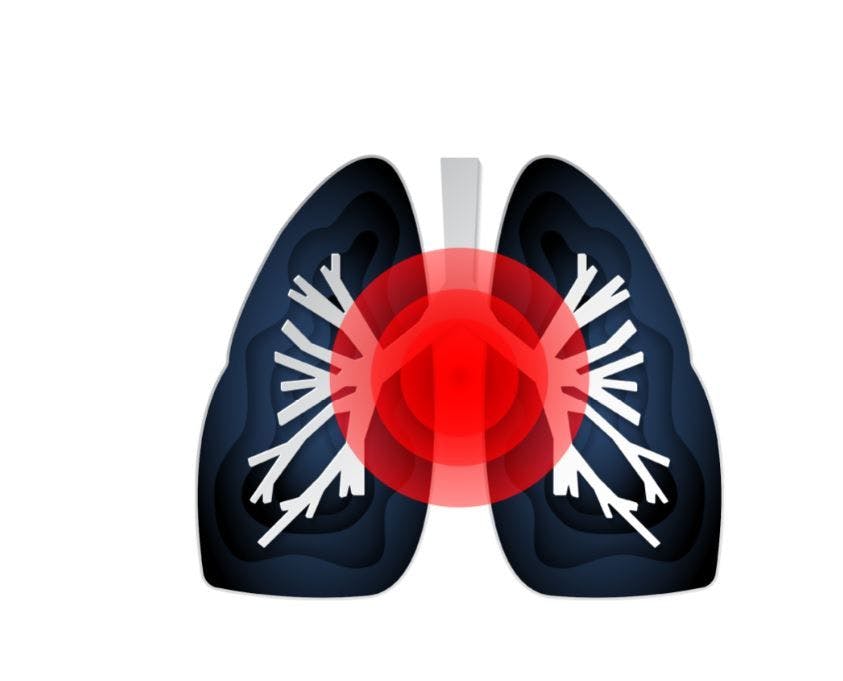 Combination Albuterol/Budesonide Now Available for Moderate-to-Severe Asthma ©Artur/stock.adobe.com 