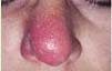 Nasal Cellulitis: MRSA Infection of the Nose 