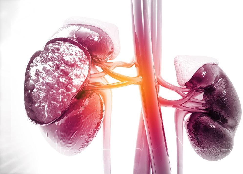 Chronic Kidney Disease Present in 1 in 10 Adults: Study of 2.4 Million People in 11 Countries