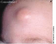 Pilomatrixoma on the Forehead of a 5-Month-Old Girl