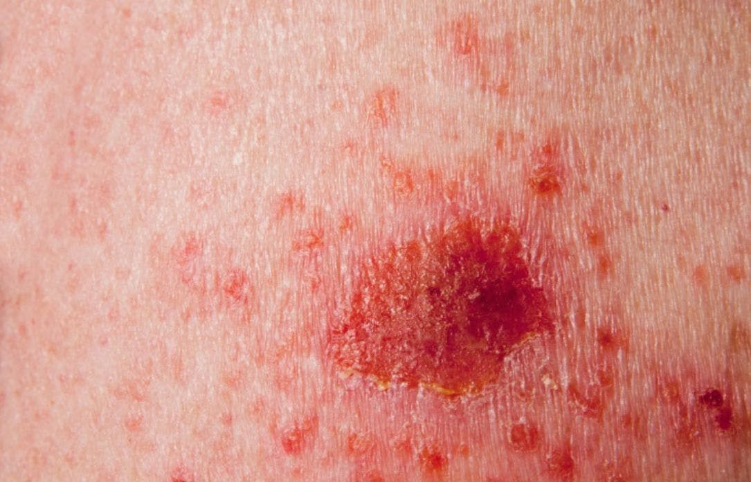 Nonmelanoma Skin Cancer: A Primer for Primary Care