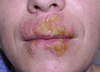 Perioral Blistering and Crusting
