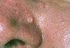Sebaceous Hyperplasia in Those With “Oily” Complexions