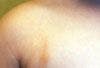 What is this pigmented papule on a toddler's shoulder?
